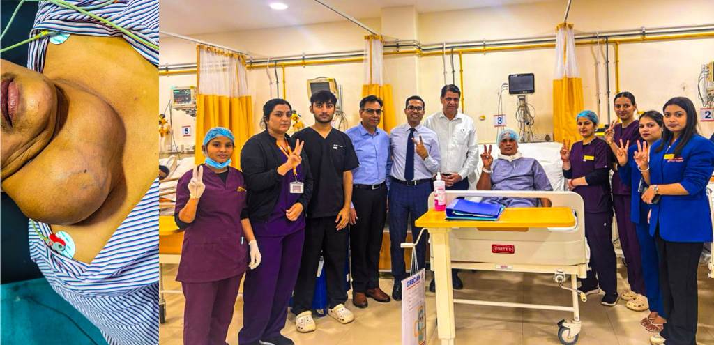 Rare 5Kilogram Thyroid Tumor Successfully Removed at Park Gracian Hospital Mohali